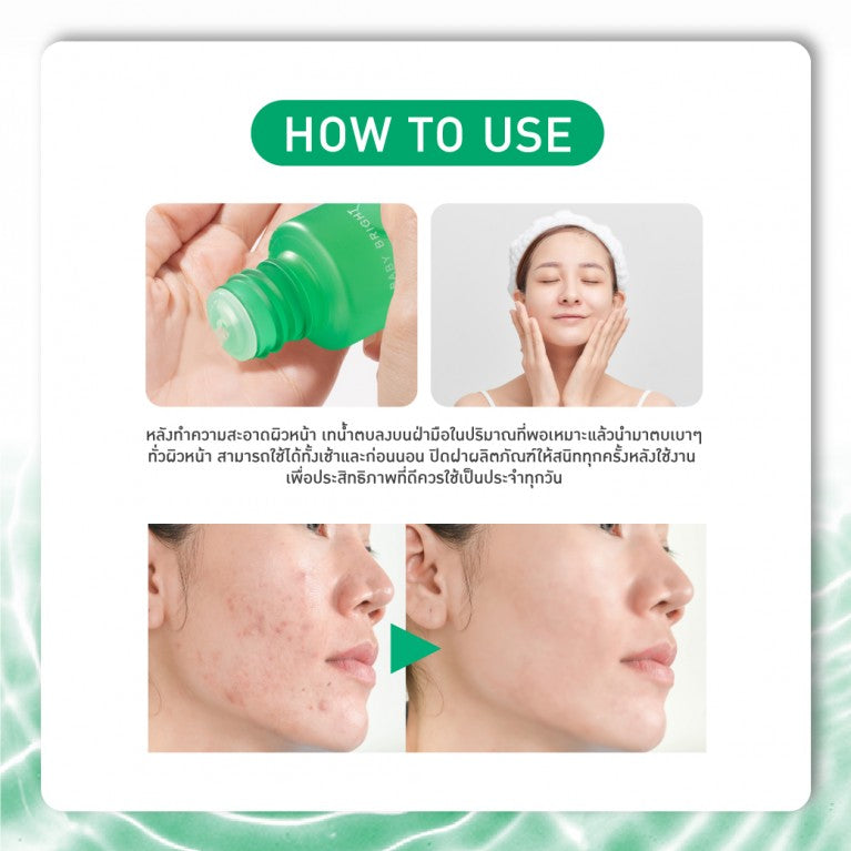 BABY BRIGHT ACNE CARE GENTLE ESSENCE 35 ML.